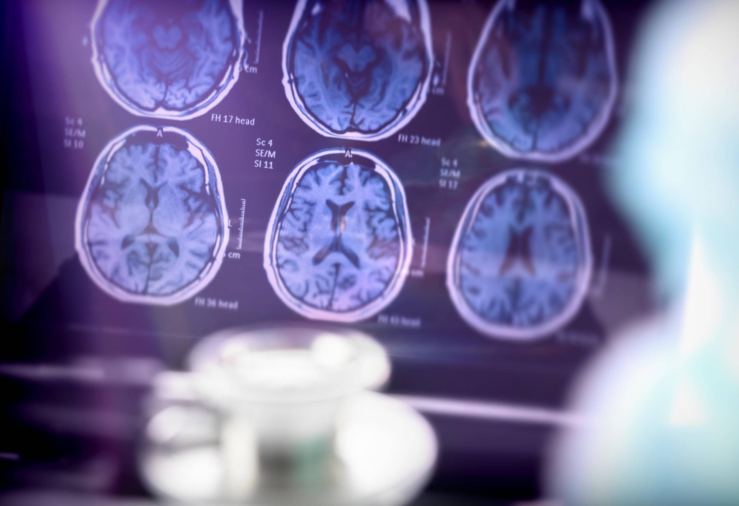 Should You Be Tested For Alzheimer S Avalon Memory Care